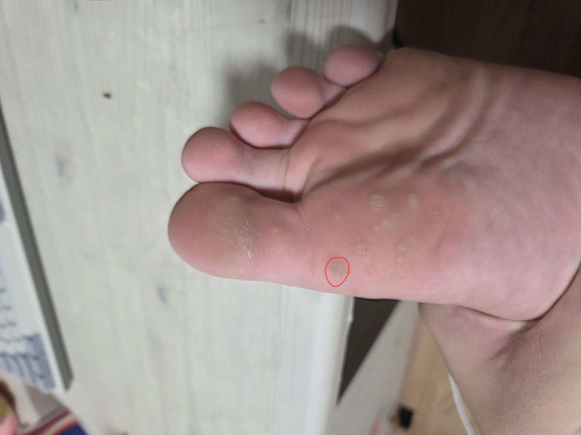 확대 해서 봐라 핵이 여러개지? 티눈은 핵이 하나임 고로 저건 사마귀 놔두면 계속 퍼짐