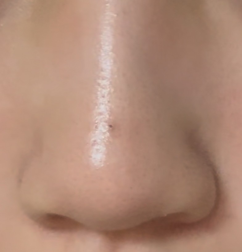 깊숙히 박힌 블랙헤드 없애는법ㅠㅠ(사진 혐오주의)