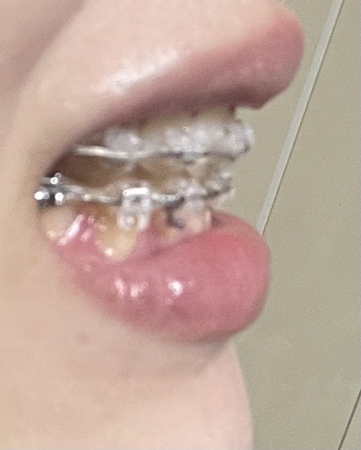 담달에 교정기 떼는데 봐주라