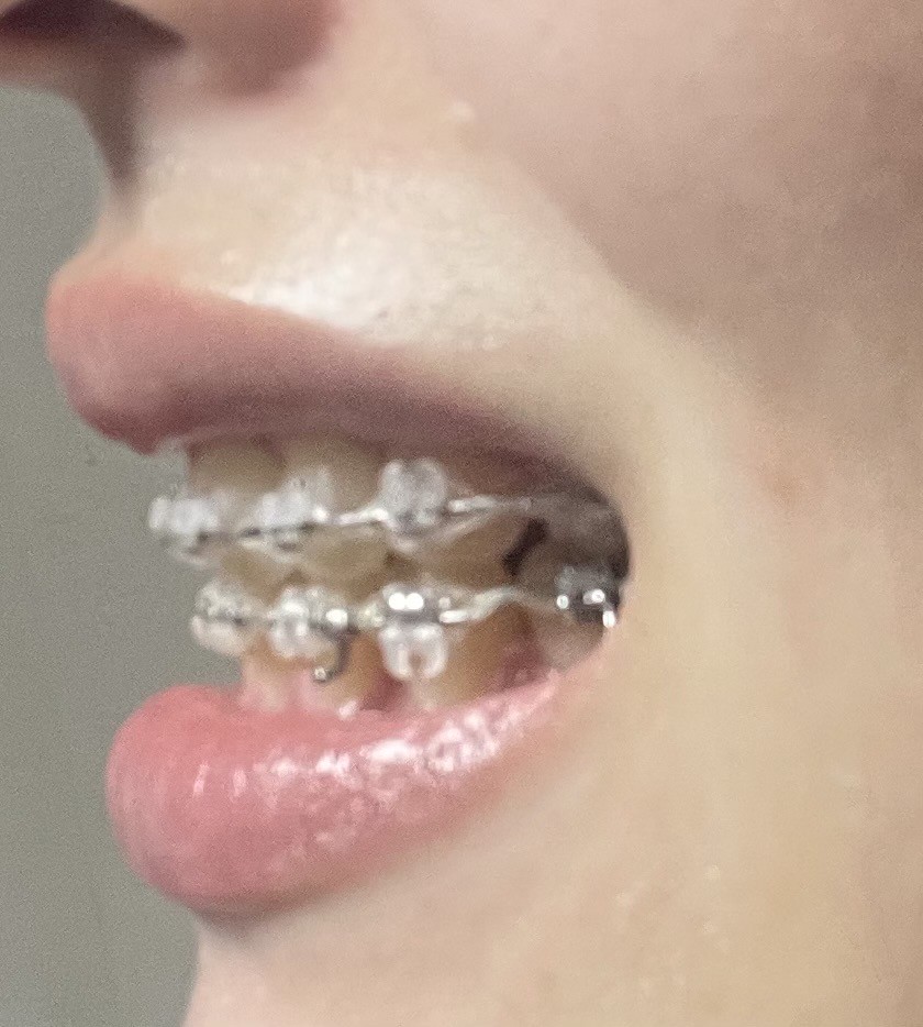 담달에 교정기 떼는데 봐주라