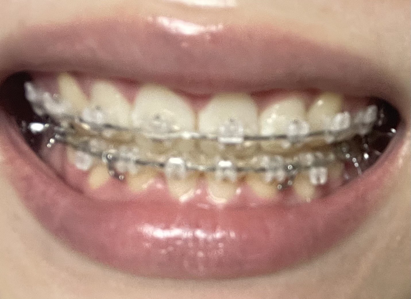 담달에 교정기 떼는데 봐주라