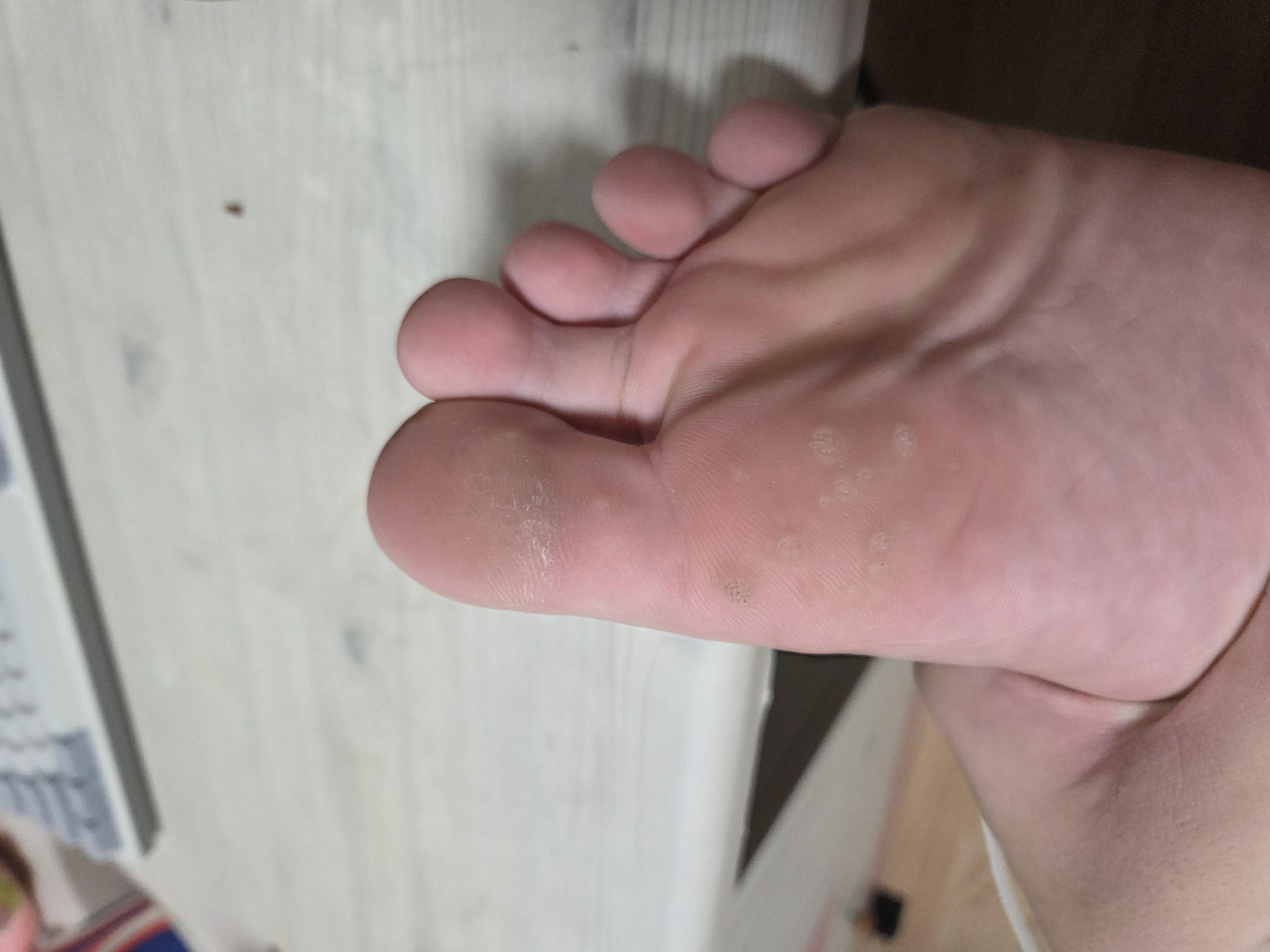 나 발가락에 티눈 있는데 어떻게 해야해?🔺️약혐주의