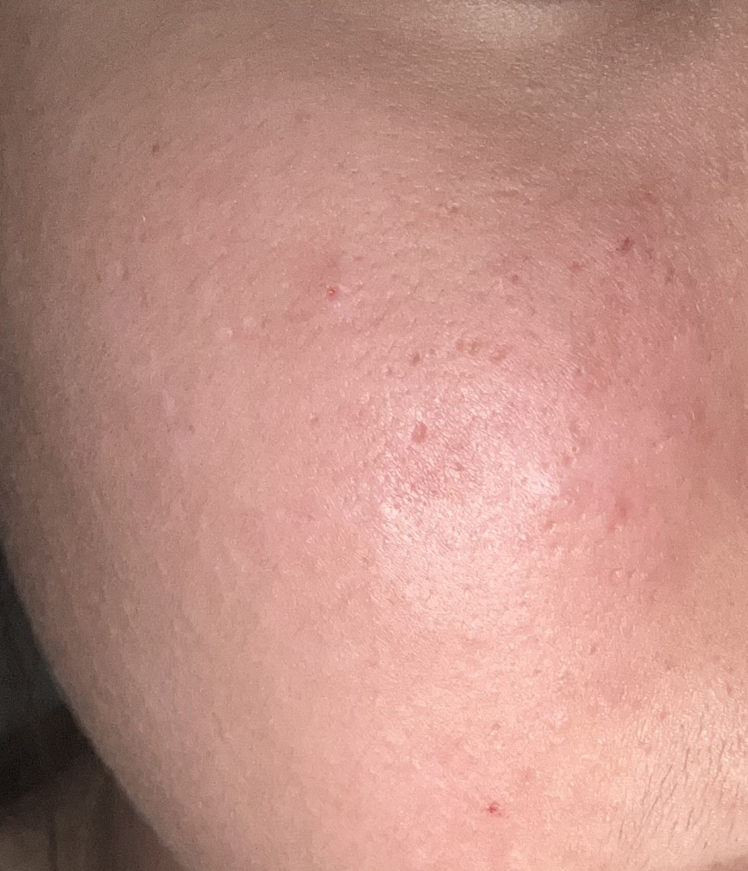 피부 고민 (피부사진 주의)