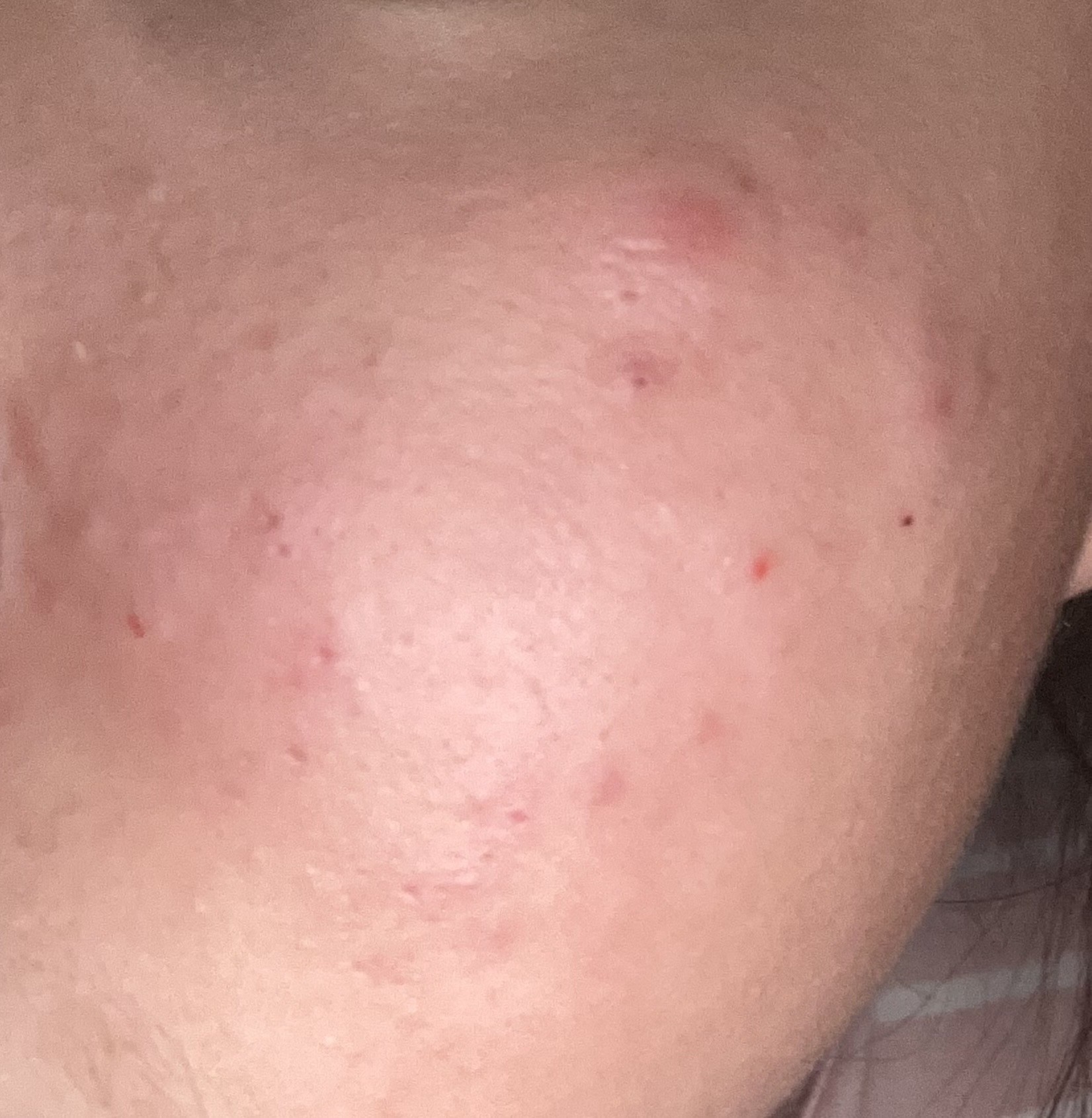 피부 고민 (피부사진 주의)