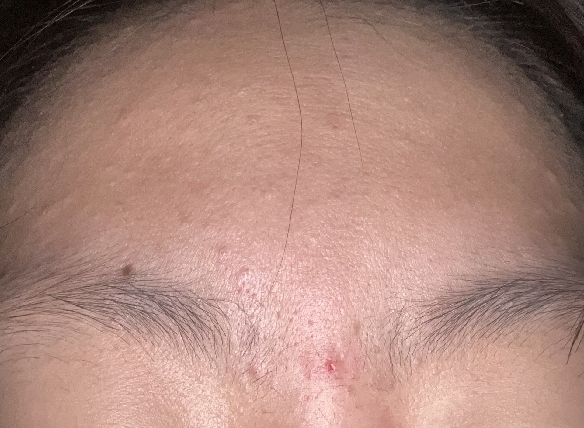 피부 고민 (피부사진 주의)