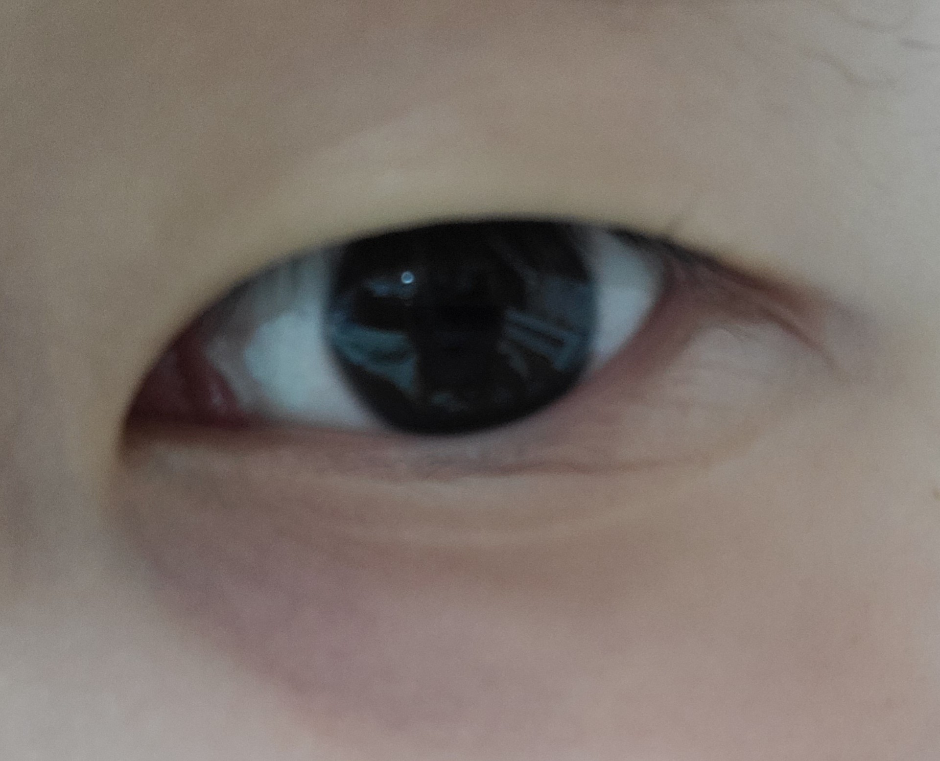 몽고주름,다크서클 없애는법 알아..?