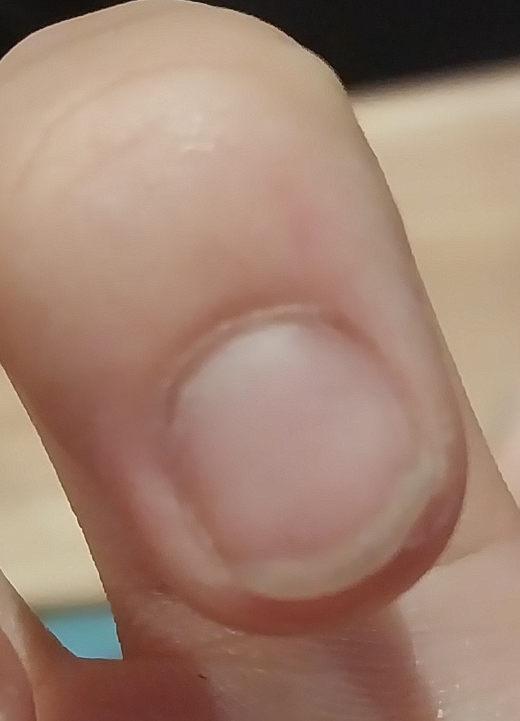 걍 증거로 올리는거임(?) 원래 난 뜯는게 심했어서 손톱 이거에 반토막나있었어ㅋㅋ