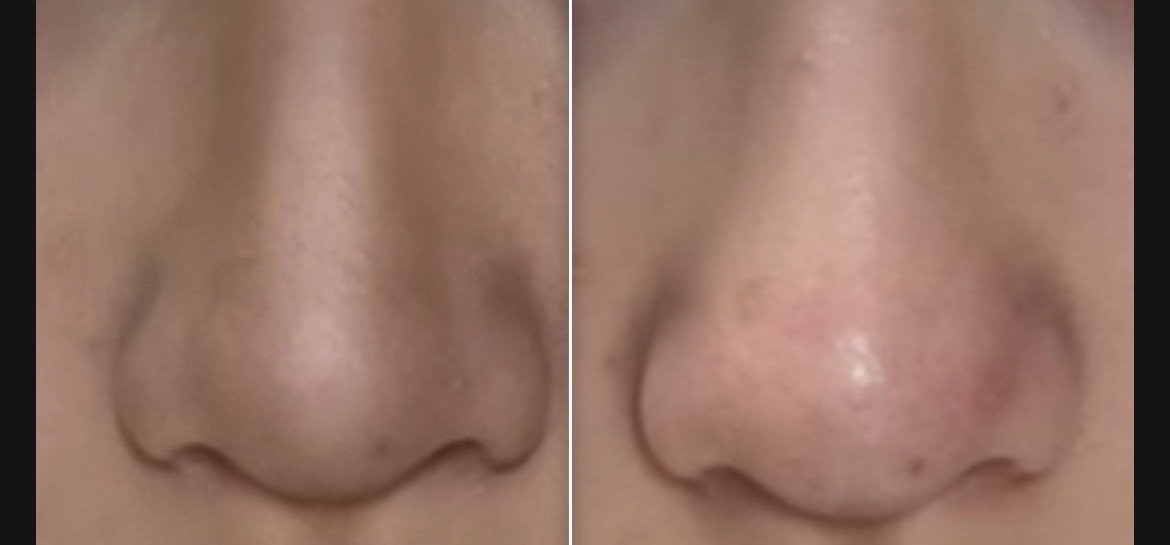 원래 코 복코라 이거 끼먼 좀 수술 잘못한 코 깉아도 원래 코보단 나은 것 깉아서… 사진은 그냥 쉐딩한거야